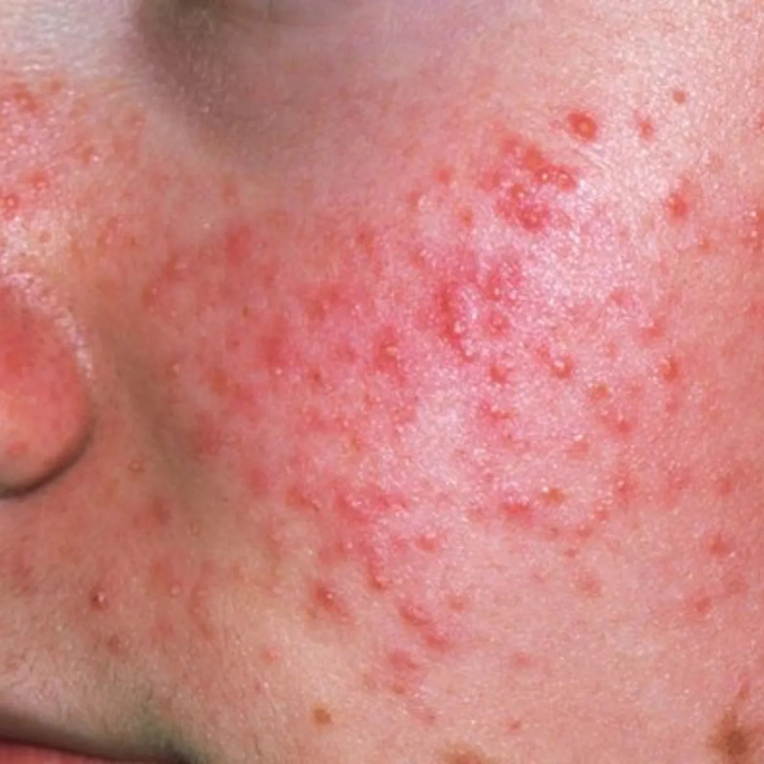 How to Clear Hormonal Acne Without Harsh Products