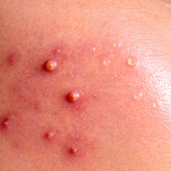 Acne & Barrier Repair