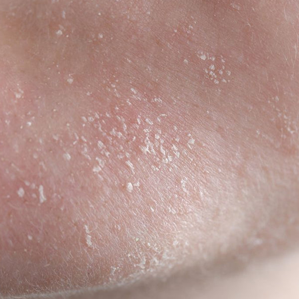 Irritated & Damaged Skin