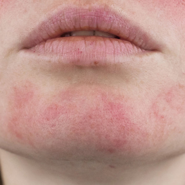 Redness & Irritation