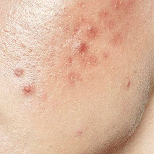Sensitive & Acne-Prone