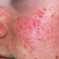 Acne